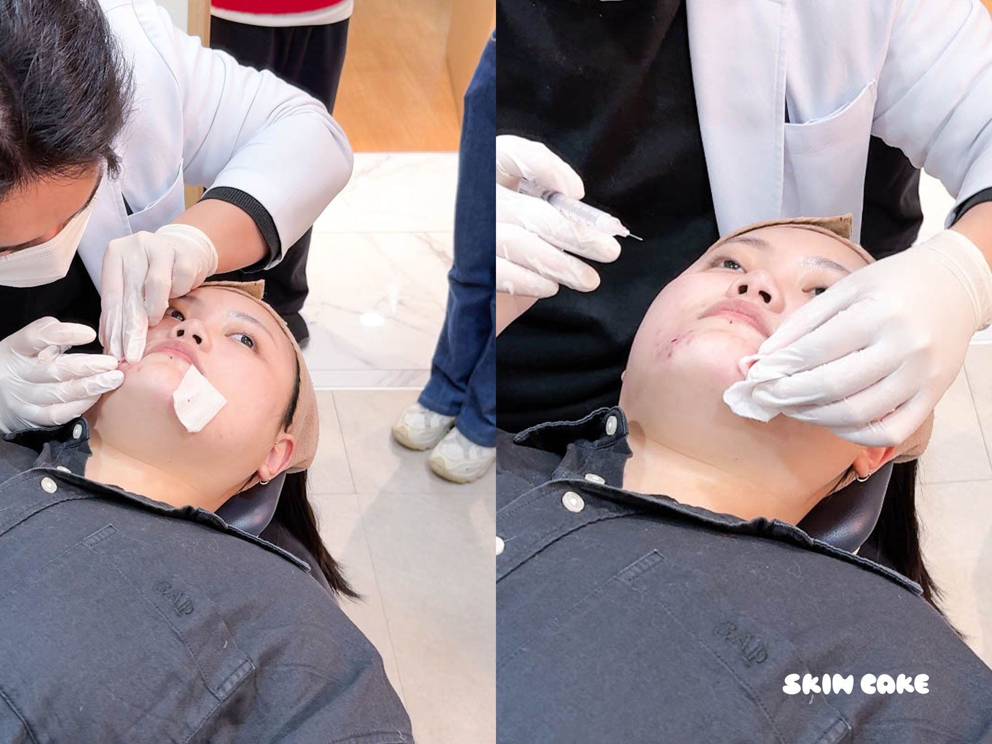 痘疤痘印再見!韓國蠶室Datena 診所痘疤痘印修復真實心得分享